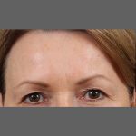 Skin Resurfacing Before & After Patient #1343
