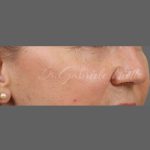Skin Resurfacing Before & After Patient #1343