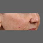 Skin Resurfacing Before & After Patient #1343