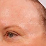 Skin Resurfacing Before & After Patient #1345