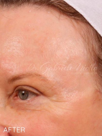 Skin Resurfacing Before & After Patient #1345