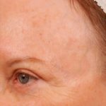 Skin Resurfacing Before & After Patient #1345
