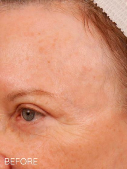 Skin Resurfacing Before & After Patient #1345