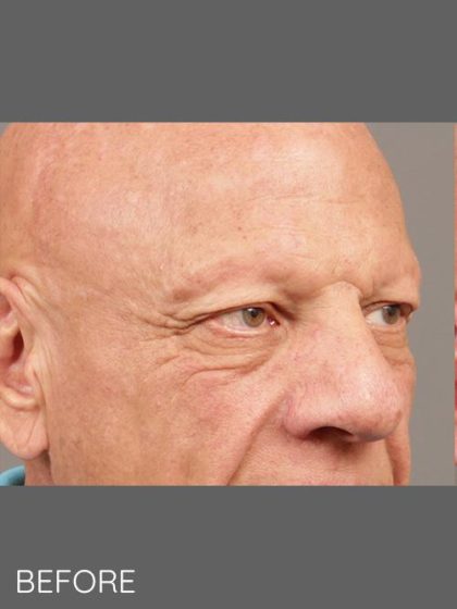 Softening of Facial Creases Wrinkles Before & After Patient #1382