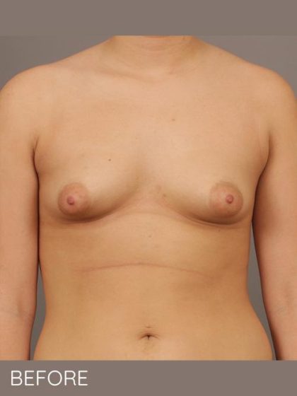 Breast Augmentation Before & After Patient #1496