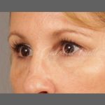 Dark Circles and Eyelid Bags Before & After Patient #1407