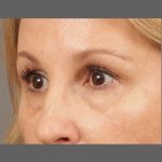 Dark Circles and Eyelid Bags Before & After Patient #1407
