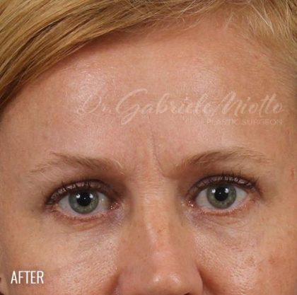 Blepharoplasty Before & After Patient #704