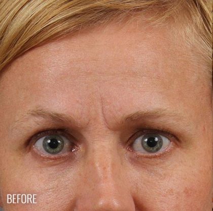 Blepharoplasty Before & After Patient #704