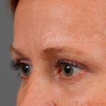 Blepharoplasty Before & After Patient #704