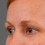 Blepharoplasty Before & After Patient #704