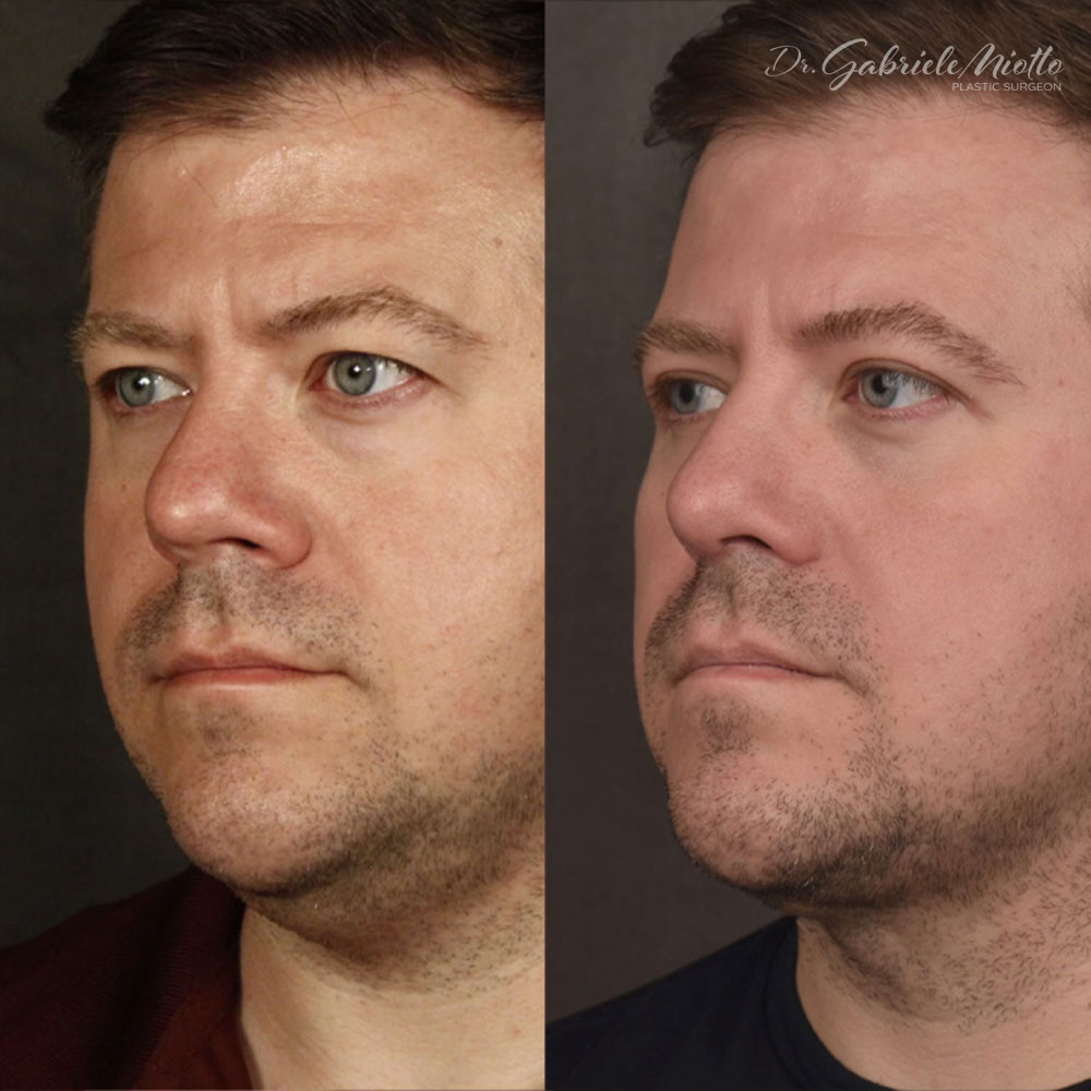 Best Rhinoplasty Atlanta, GA | Dr. Gabriele Miotto