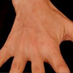 Fat Grafting to The Hands Before & After Patient #1280