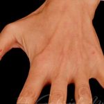 Fat Grafting to The Hands Before & After Patient #1280