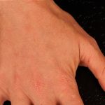 Fat Grafting to The Hands Before & After Patient #1280