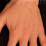 Fat Grafting to The Hands Before & After Patient #1280