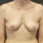 Breast Implant Removal Before & After Patient #1582