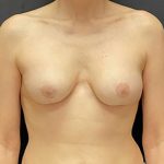 Breast Implant Removal Before & After Patient #1582