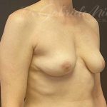Breast Implant Removal Before & After Patient #1582