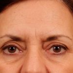 Brow Lift Before & After Patient #142
