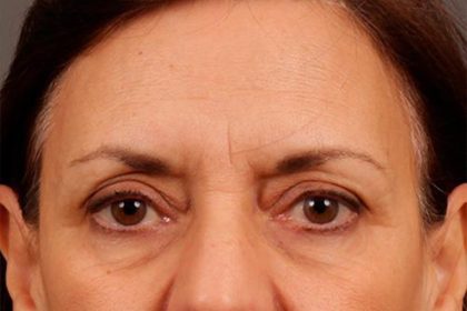 Brow Lift Before & After Patient #142