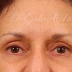 Brow Lift Before & After Patient #142