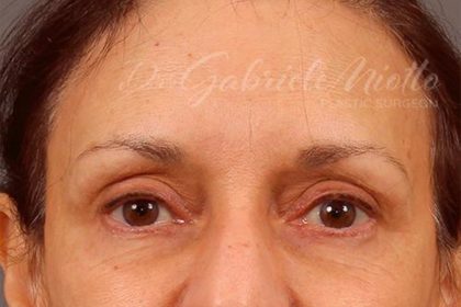 Brow Lift Before & After Patient #142