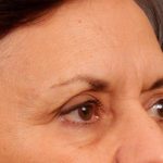 Brow Lift Before & After Patient #142