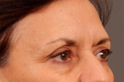 Brow Lift Before & After Patient #142