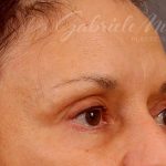 Brow Lift Before & After Patient #142
