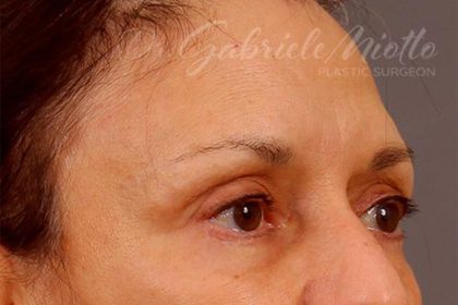 Brow Lift Before & After Patient #142