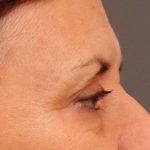 Brow Lift Before & After Patient #142