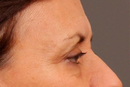 Brow Lift Before & After Patient #142