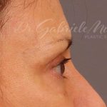 Brow Lift Before & After Patient #142