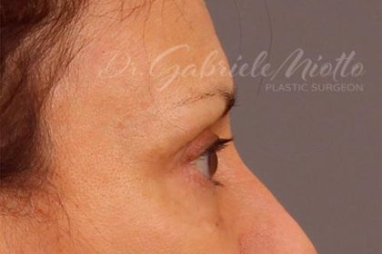Brow Lift Before & After Patient #142