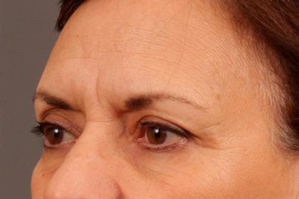 Brow Lift Before & After Patient #142