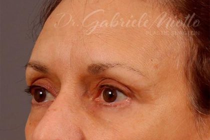 Brow Lift Before & After Patient #142