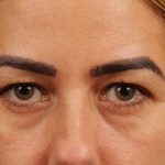 Blepharoplasty Before & After Patient #144