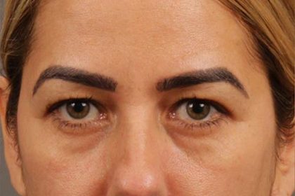 Blepharoplasty Before & After Patient #144