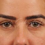 Blepharoplasty Before & After Patient #144