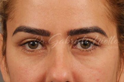 Blepharoplasty Before & After Patient #144