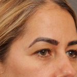 Blepharoplasty Before & After Patient #144
