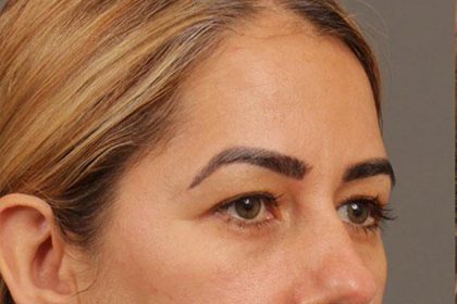 Blepharoplasty Before & After Patient #144