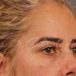 Blepharoplasty Before & After Patient #144