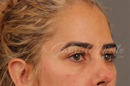 Blepharoplasty Before & After Patient #144