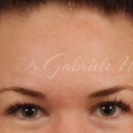 Brow Lift Before & After Patient #145