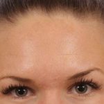 Brow Lift Before & After Patient #145