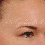 Brow Lift Before & After Patient #145
