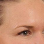 Brow Lift Before & After Patient #145