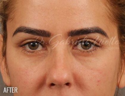 Brow Lift Before & After Patient #144